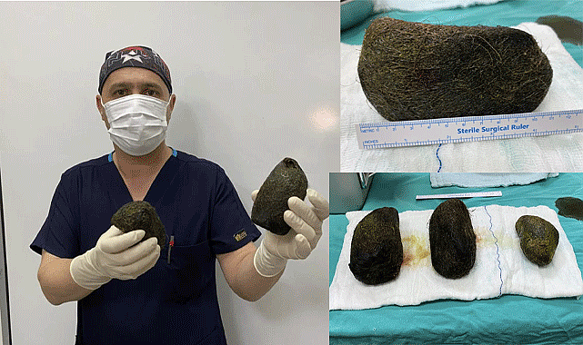 Midesinden 2 kilo saç çıktı!