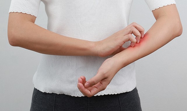 Soğuk hava ve rüzgar egzamayı tetikliyor!