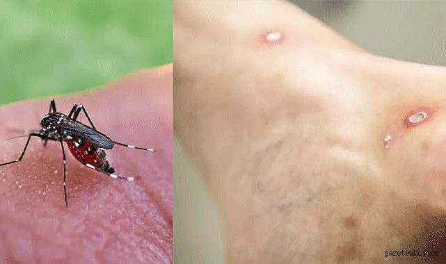 Yeni virüs Maymun Çiçeğinden daha tehlikeli